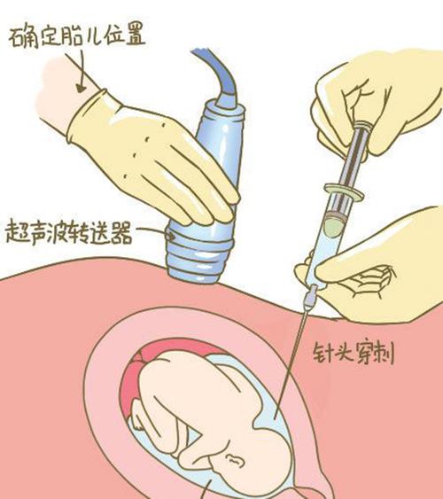 嘉兴羊水孕期亲子鉴定